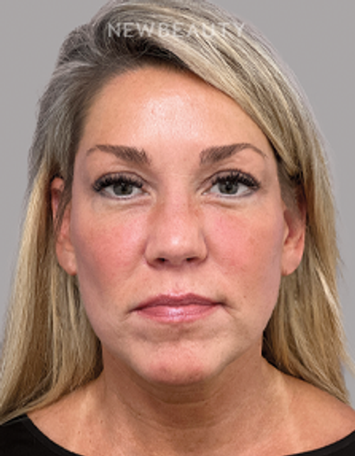 Dr. Michael A. Epstein - Elegant Facial Rejuvenation - 33109024 - After