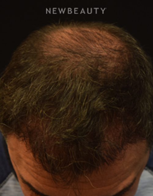 Dr. Jeffrey B. Wise - Thinning Hair Resotration - After