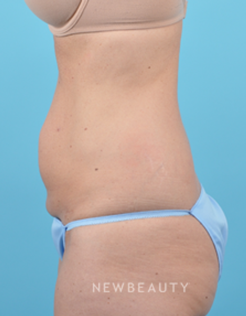 Dr. Bradley Bengtson - CoolSculpting - Before
