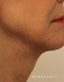 Dr. Kimberly Lee- Facelift - After