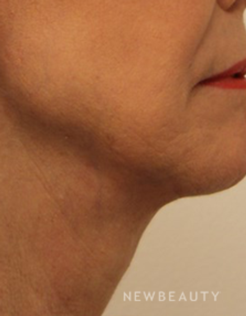 Dr. Kimberly Lee- Facelift - After