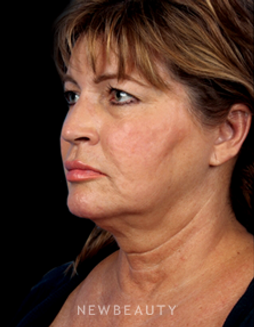 Dr. Kelly Bomer - Facelift - Before