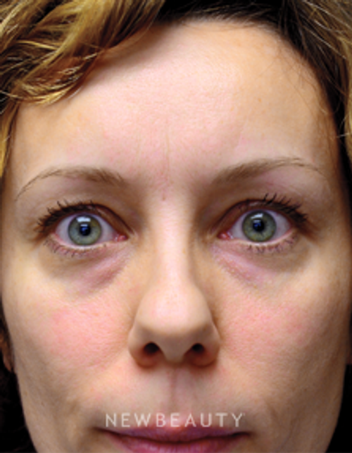 Dr. Mokhtar Asaadi - Eyelift - Before