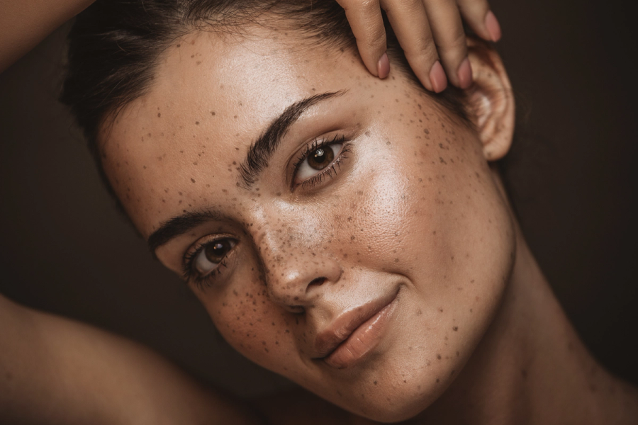 Happy National Microneedling Day! Here’s Everything You Need to Know About Vivace RF Microneedling