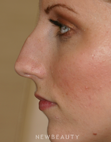 Dr. Lee Ann Klausner Rhinoplasty - Before