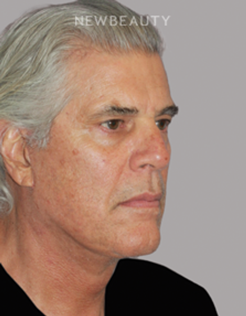 Dr. Konstantin Vasyukevich – Deep Plane Face and Neck Lift – 46903643 - After