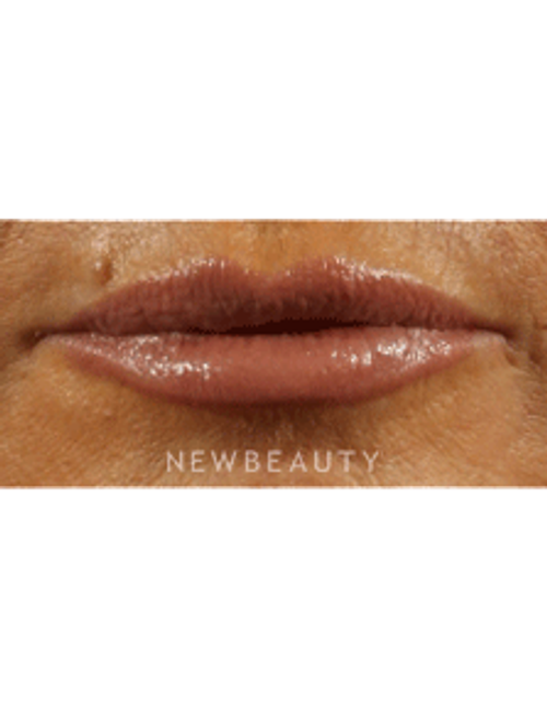 Dr. Marina Peredo Lip Augmentation - After
