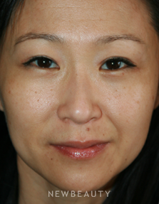 Dr. John Kang - Blepharoplasty - After
