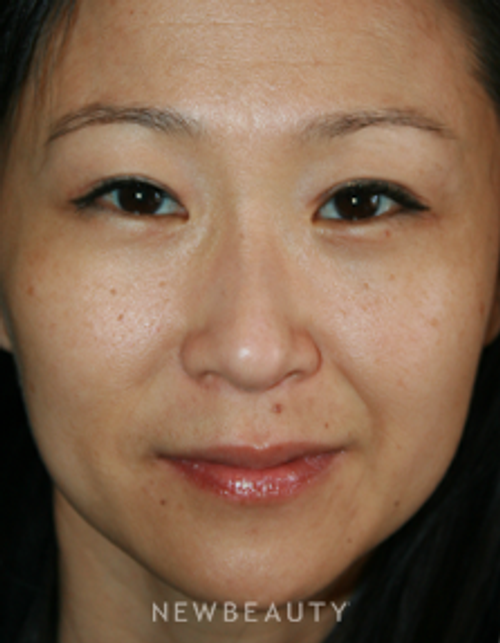 Dr. John Kang - Blepharoplasty - After