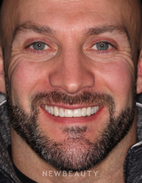 Dr. Neal Patel - Veneers - After