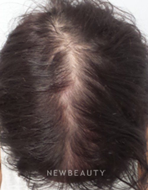 Dr. Marina Peredo - Hair-Loss Treatment - After