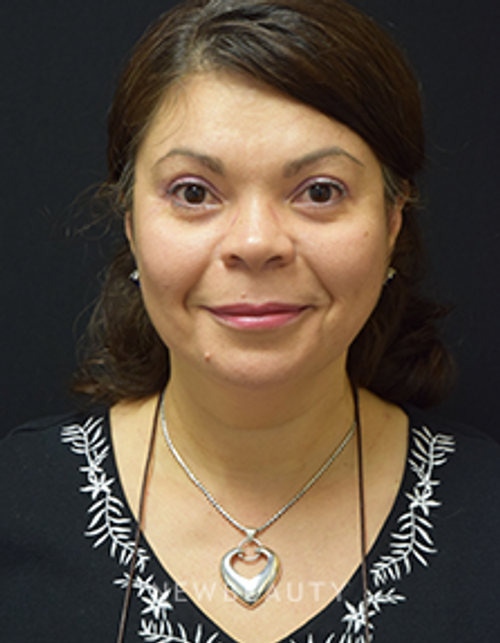 Dr. Jeffrey B. Wise - Eyelift, Facelift, Necklift - After
