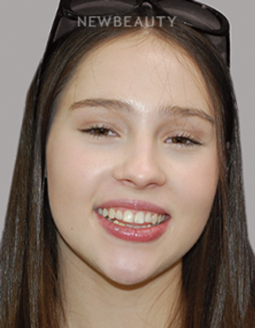 Dr. Salvator La Mastra - Smile Makeover -46108811 - Before