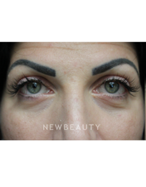Dr. Joseph Russo - Youthful Look (Eye EBG) - After