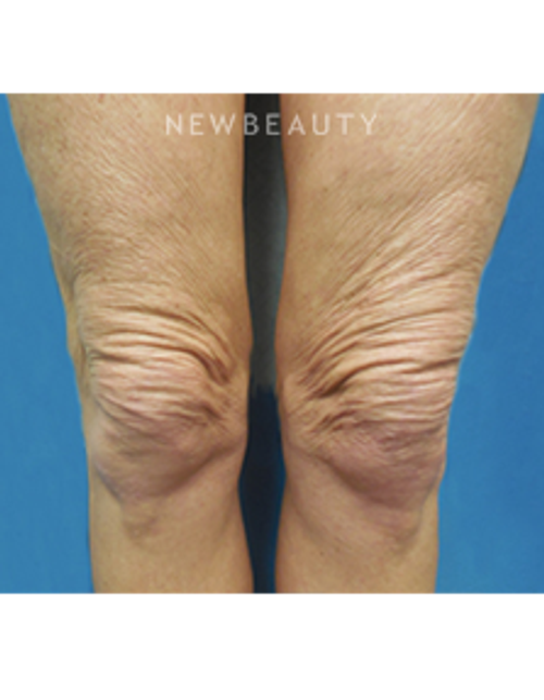 Dr. Christine Hamori - Thermage - Before