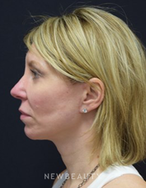 Dr. Jeffrey B. Wise - Facelift - After