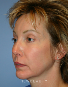 Dr. Kelly Bomer, Facelift, Chin Augmentation - Before