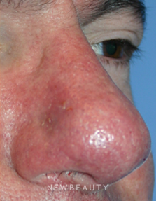 Dr. Kelly Bomer, Spider Vein Treatment - After