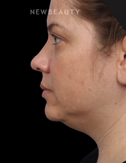 Dr. Kathleen Behr - Double Chin Reduction - Before