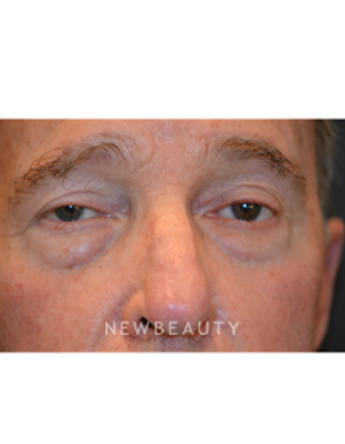 Dr. Aviva Preminger - Lower Blepharoplasty - Before