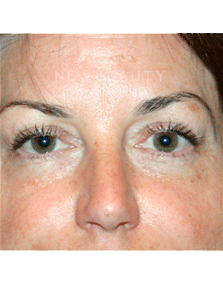 Dr. Kelly Bomer Liquid Facelift - Before