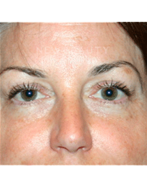 Dr. Kelly Bomer Liquid Facelift - Before