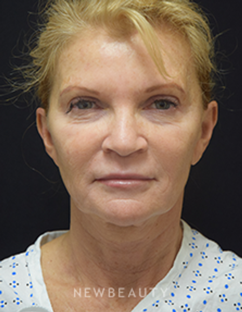 Dr. Jeffrey B. Wise - Facelift - Before