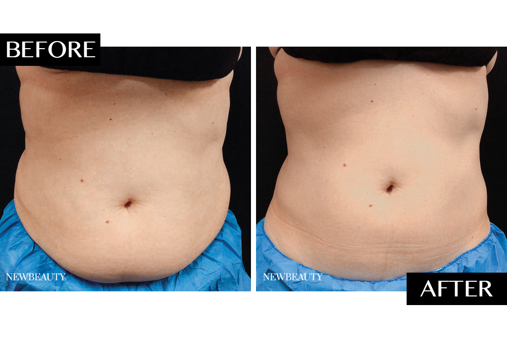 coolsculpting
