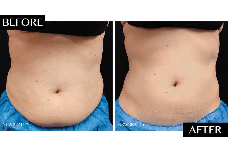 coolsculpting