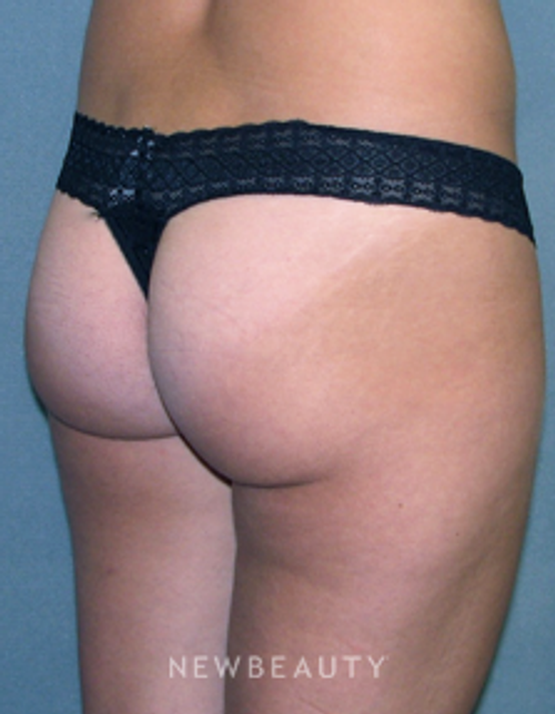 Dr Sean Simon Butt Augmentation - Before