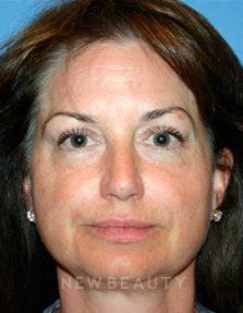 Dr. Kelly Bomer Liquid Facelift - Before