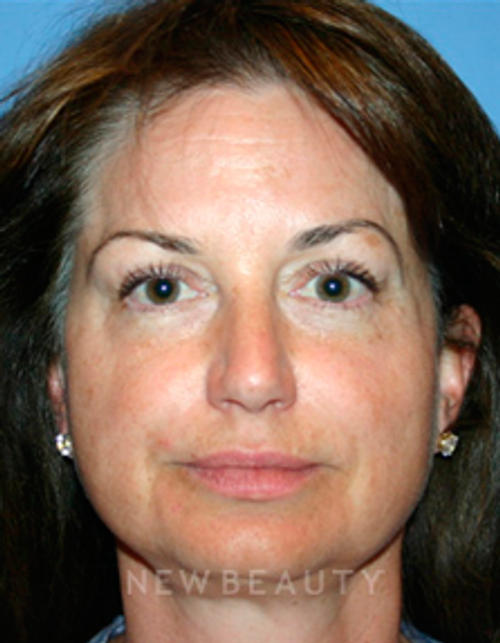 Dr. Kelly Bomer Liquid Facelift - Before