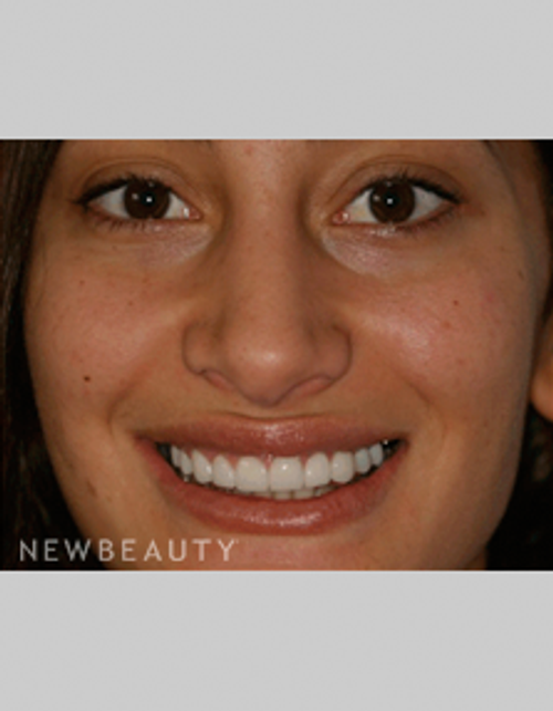 Dr. Bob Perkins Veneers - After