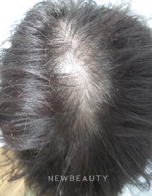 Dr. Marina Peredo - Hair-Loss Treatment - Before