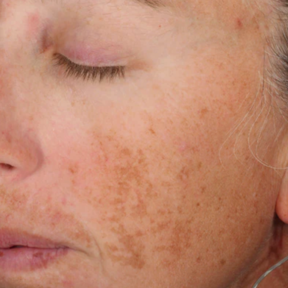 ALASTIN Skincare® Regimen: Gentle Cleanser, A-LUMINATE Brightening Serum™, Ultra Light Moisturizer, SPF 50 Sunscreen. Timeframe: 12 weeks. Imaging Equipment & Analysis: VISIA® (Canfield Scientific Inc., Parsippany, NJ) Reference: Multi-Center, Randomized, Blinded, Clinical Study Evaluating the Efficacy and Safety of a Topical Product for Facial Dyschromia, n=43; photographs are unretouched. Individual results may vary. Photography courtesy of DMR Research, Westport, CT.