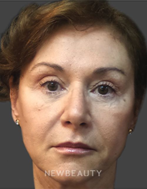 Dr. Deborah Longwill - Facial Rejuvenation - After