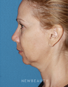 Dr. Konstantin Vasyukevich, Traditional Facelift - Before