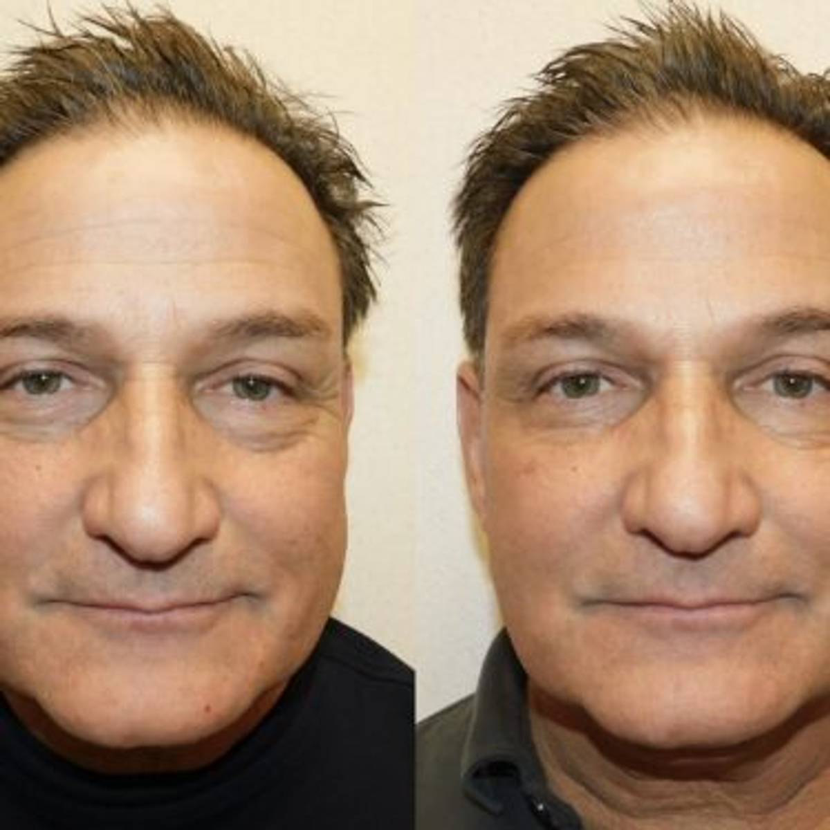 Schlessinger Male Injectables Gallery