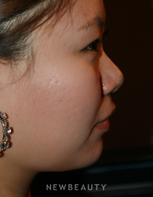 Dr. John Kang - Upper Blepharoplasty & Rhinoplasty - Before