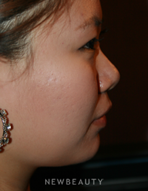 Dr. John Kang - Upper Blepharoplasty & Rhinoplasty - Before