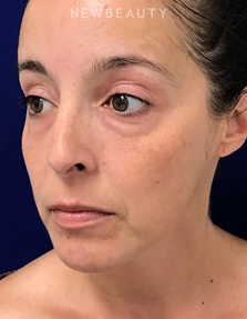 Dr. Dilip Madnani - Cheek Filler - Before