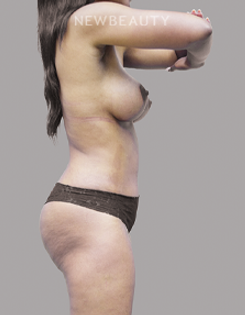 Dr. Olga Bachilo - Mommy Makeover - 28651905 - After