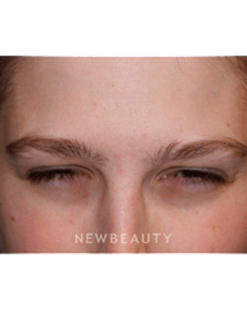 Dr. Marina Peredo Botox - After