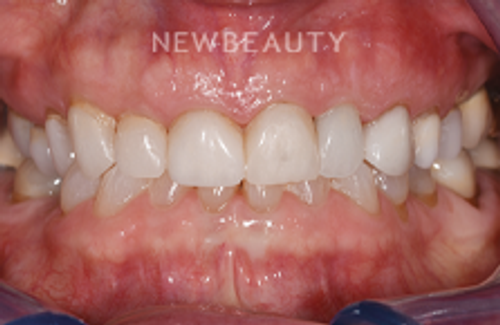Dr. Sara Cummins - Smile Makeover - 14738160 - Before