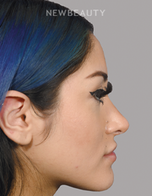Sam P Most, MD - 21009796 - Rhinoplasty - After