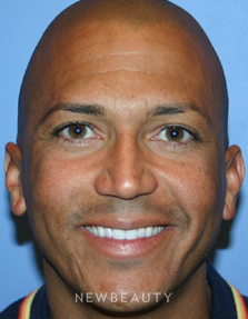 Dr. Kelly Bomer, Injections/Liquid Lift - Before