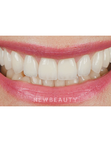 Dr. Husam Almunajed - Smile Makeover - After