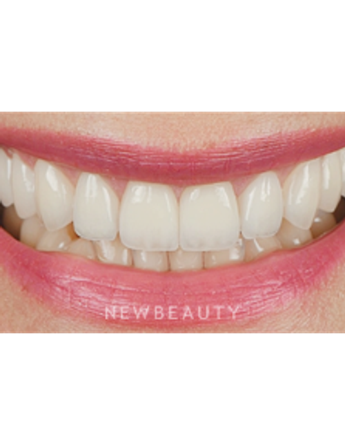 Dr. Husam Almunajed - Smile Makeover - After