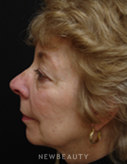 Dr. Mokhtar Asaadi Eyelid Lift - Before