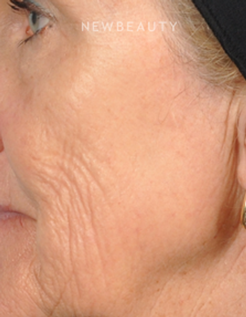 Dr. Bradley Bengtson - Skin Rejuvenation - Before